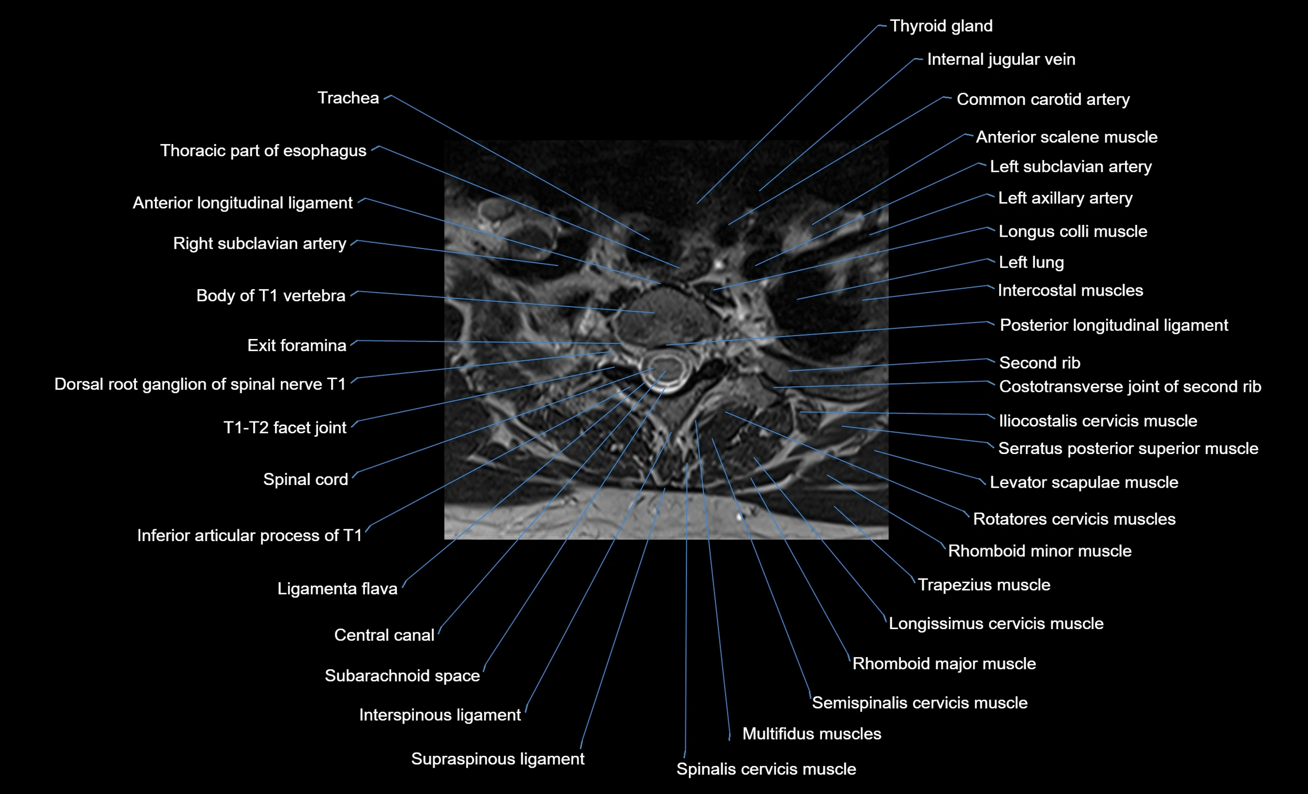 cervical spine cross sectional MRI anatomy  3T MRI axial  image-img-00001-00043.webp